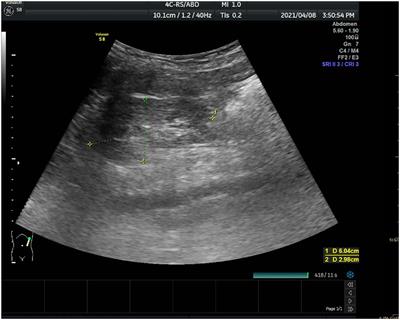 Case Report: Cystinosis in a Chinese Child With a Novel CTNS Pathogenic Variant